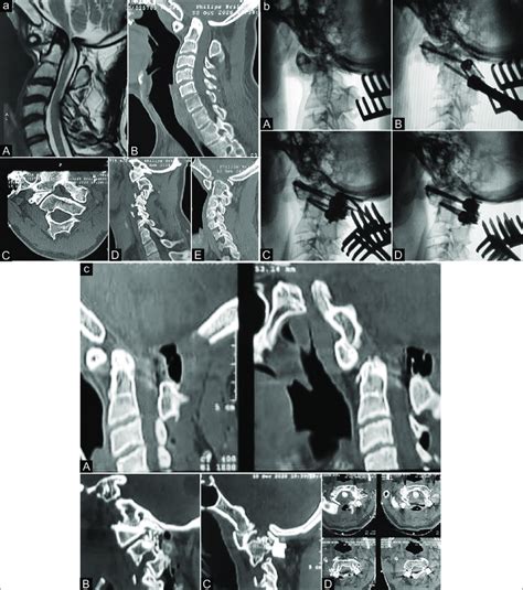 A Preoperative Magnetic Resonance Imaging And Computed Tomography