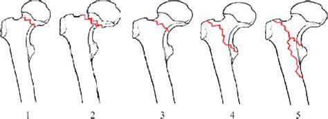 Proximal Femoral Fracture