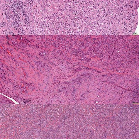 Histologic Presentation Of 3 Major Malignant Mesothelioma Types