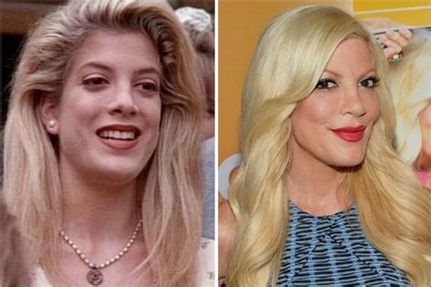 Tori Spelling Before and After Plastic Surgery