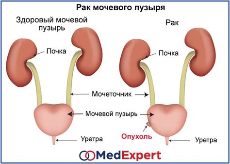 РАК МОЧЕВОГО ПУЗЫРЯ | Раковые клетки, Пузыри, Лимфатические узлы