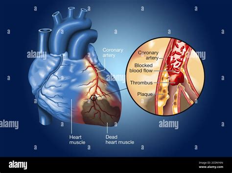 Placa en arteria coronaria coágulo de sangre trombo que se rompe y