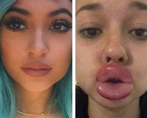 Kylie Jenner Lip Challenge Gone Way Wrong