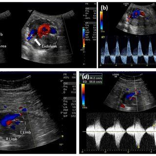 Three Dimensional Contrast Enhanced Ultrasound Done Intraoperatively