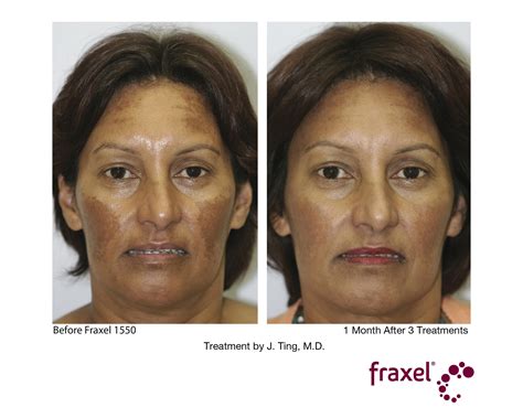 Fraxel Laser Treatment Cost Results Studiomd Midtown Manhattan Nyc