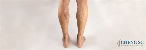 Understanding The Risks Of Untreated Varicose Veins