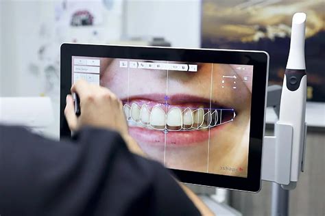 Digital Smile Design Oris Dental Richmond Hill 647 367 6747