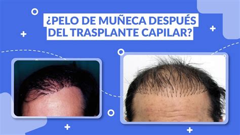 Pelo de muñeca después del trasplante capilar YouTube