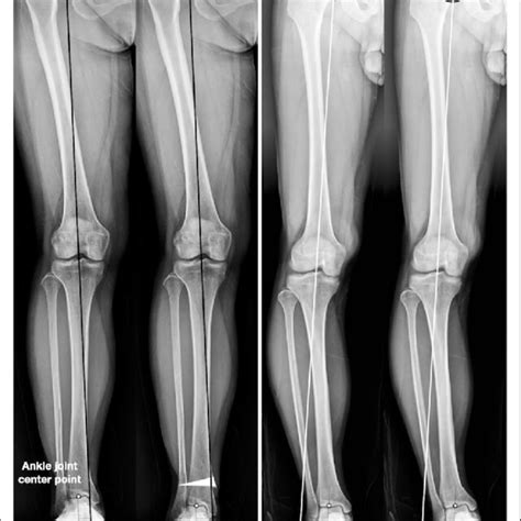 Weightbearing Radiographs Before A And After B Dome Supramalleolar