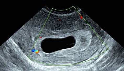 Does Hcg Continue To Rise With Blighted Ovum Huff Hatrance