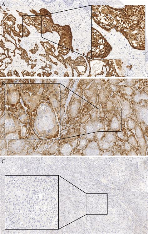 Immunohistochemical Staining Of P16 A Positive Sample In The Detail Download Scientific