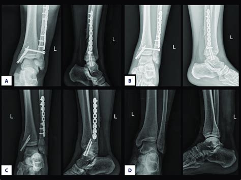 Postoperative Radiographs After The Surgery A Anteroposterior And