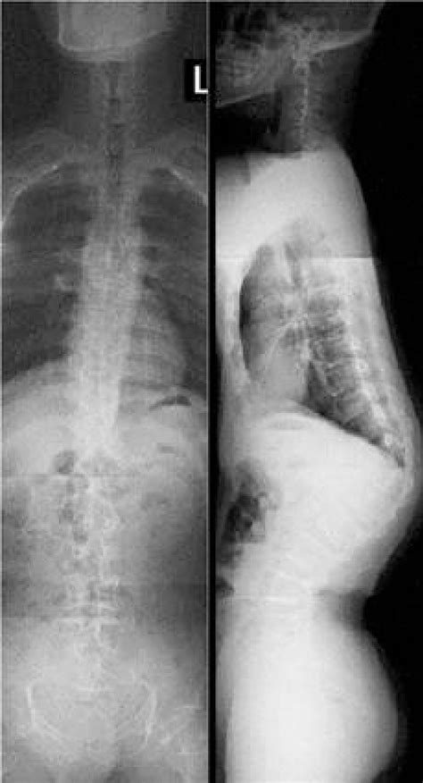 2 The Simple Radiography Of Spine Anteroposterior And Lateral View