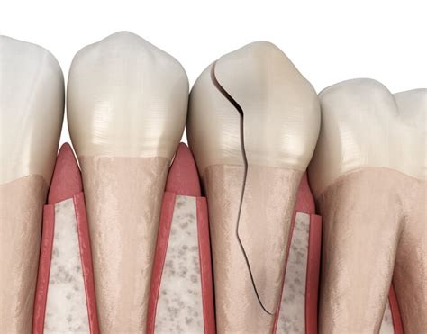 Tooth Fracture Types Treatments And Prevention Strategies