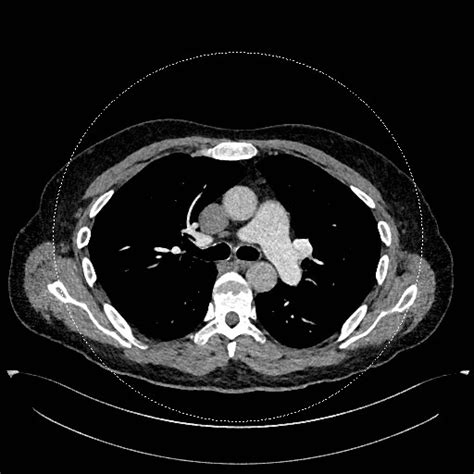 Right Lower Lobe Pulmonary Embolus Image