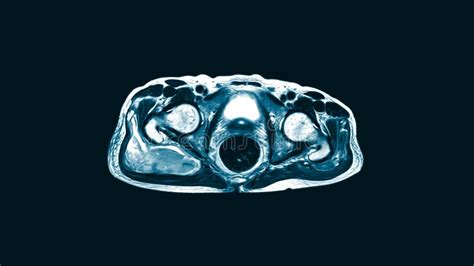 Magnetic Resonance Imaging Mri Of Both Hip Sagittal Plane Finding A