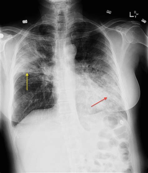 Right Upper Lobe And Lingular Consolidation Radiology At St Vincent S University Hospital