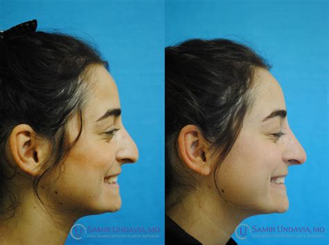 Nonsurgical Rhinoplasty Botox Fillers Rhinoplasty Botox