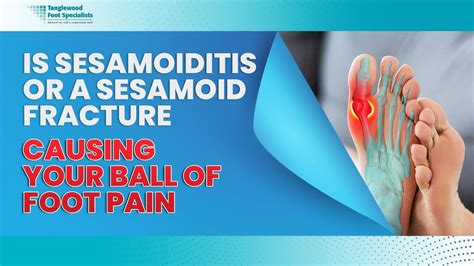 Is Sesamoiditis Or A Sesamoid Fracture Causing Your Ball Of Foot Pain