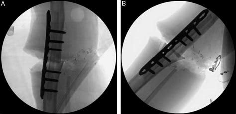 Intraoperative Lateral A And Anteroposterior B Fluoroscopic Images