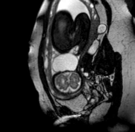 Cystic hygroma vs occipital meningocele | Radiology Reference Article ...