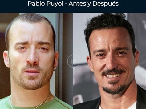 Injerto Capilar Antes Y Despu S De Famosos Descubre Su Transformaci N