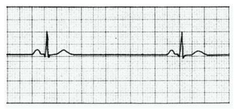 Cardiac Dysrhythmia Ekg Strips Flashcards Quizlet