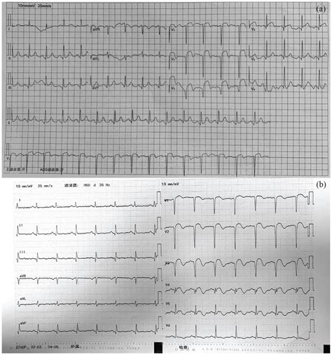 (a) Electrocardiogram (ECG) displaying ST-segment elevation in leads ...
