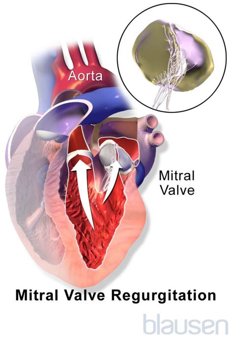 Image Mitral Valve Regurgitation Msd Manual Consumer Version