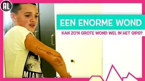 Wat Als Je Hele Arm Een Wond Is Topdoks Seh Youtube