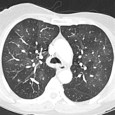 Bronchiolitis A Practical Approach For The General Radiologist