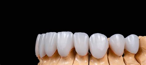 Emax Veneers In Turkey Prices Pros And Reviews Dentatur