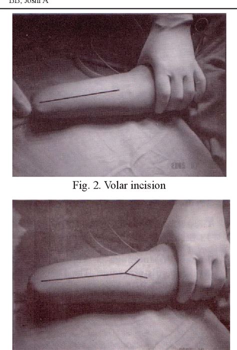 Figure 3 from Management of double hand amputees with Krukenberg ...