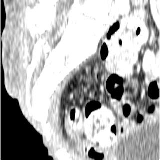 Preoperative Computed Tomography Scan Showing The Three Dimensional