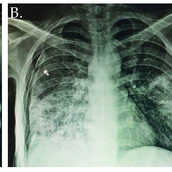 Chest radiography studies. (A,B) shows chest radiography study of Case ...