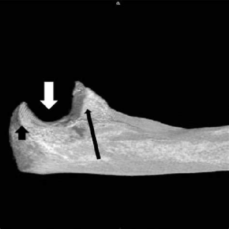 Normal Variant Of The Elbow The Supracondylar Process Or Avian Spur