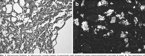 Figure From Review Of Acquired Cystic Disease Associated Renal Cell