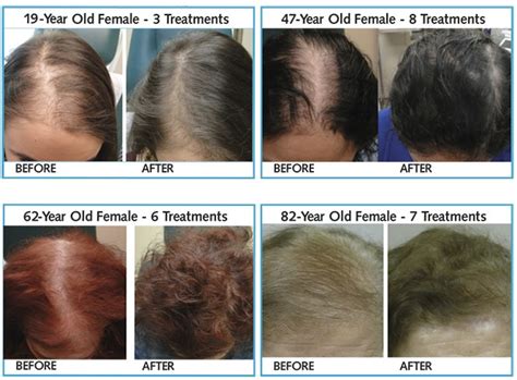 PRP Treatment For Thinning Hair And Early Stage Hair Loss