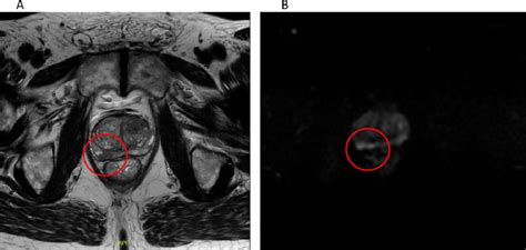 A T2 Weighted Magnetic Resonance Image Of The Prostate Tumor Is