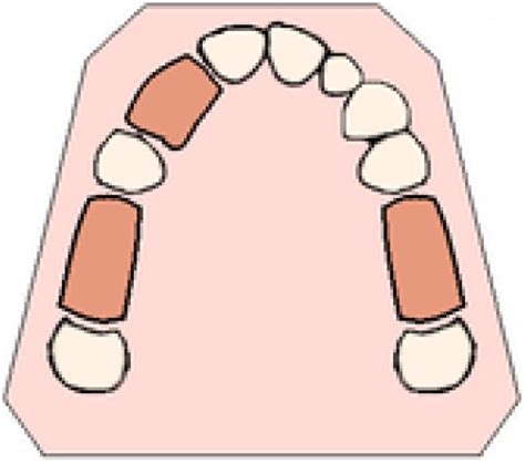 Kennedy Classification And Applegates Rule Focus Dentistry