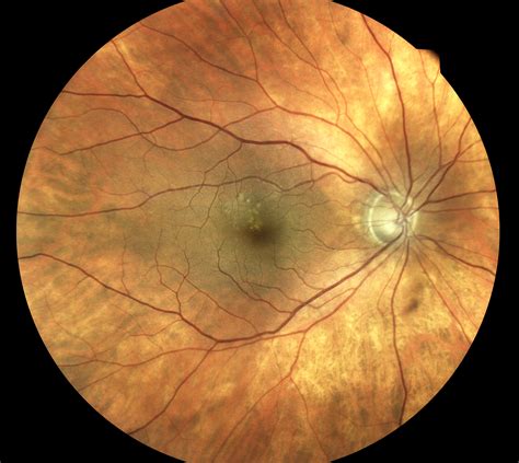 Ir Imaging Retina And Eidon