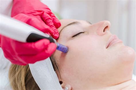 1 Session Of Microneedling Bellaesthetic