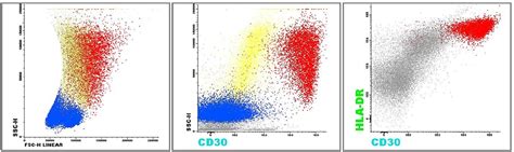 SciELO Brasil Linfoma anaplásico de células grandes associado a