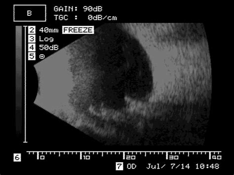 B-mode ultrasound scan of the patient's left eye. A high-luminance ...