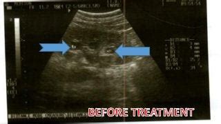 PUJ or UPJ Obstruction (Pelvic Ureter Junction Obstruction ...