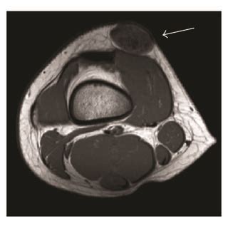 Ap A And Lateral B Radiographic Imaging Of Distal Femur