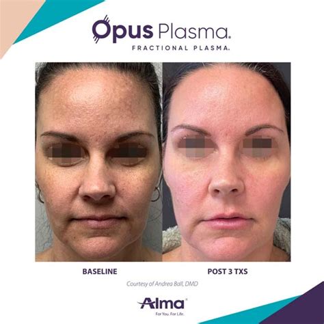 Opus Plasma Skin Tightening Gallery The Beauty Spot In Boulder Colorado