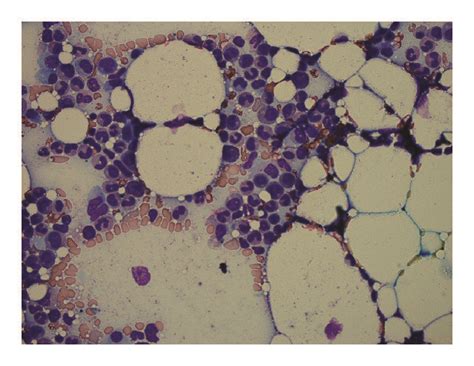 Engrafting Bone Marrow With Trilineage Hematopoiesis And Decreased