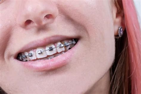 Everything You Need To Know About Self Ligating Braces