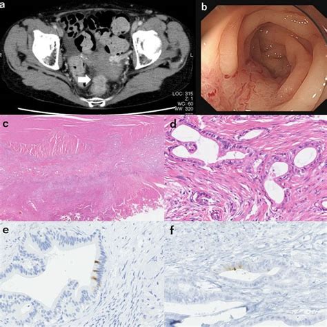 A Contrast Enhanced Computed Tomography Showed A Mass Between The